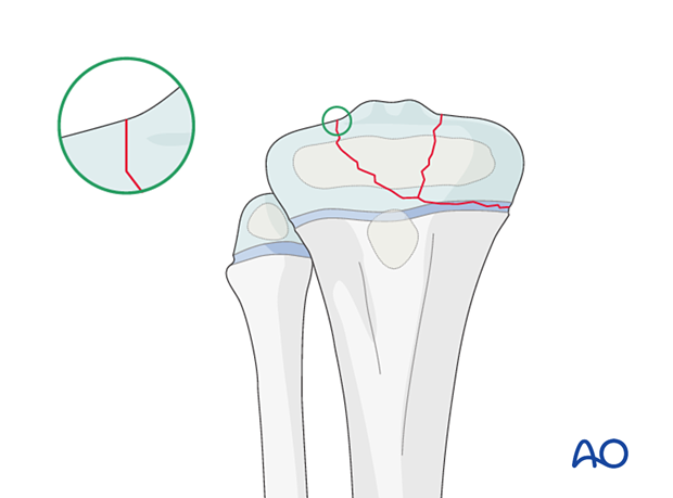 Multifragmentary Salter-Harris type-III proximal tibial fracture