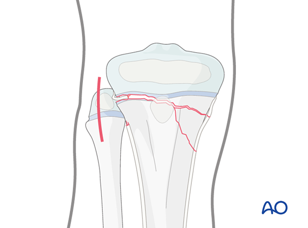 Interposed periosteum in a multifragmentary Salter-Harris type-II fracture of the proximal tibia and the corresponding skin incision for its reduction