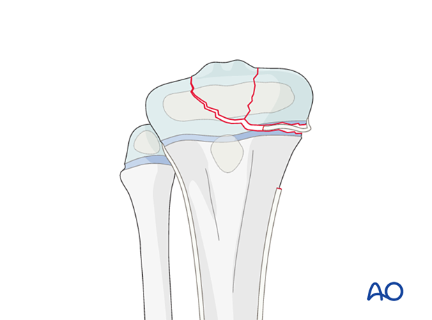 Interposed periosteum in a multifragmentary Salter-Harris type-III proximal tibial fracture