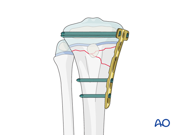 Open reduction and plate fixation of a proximal metaphyseal tibial fracture