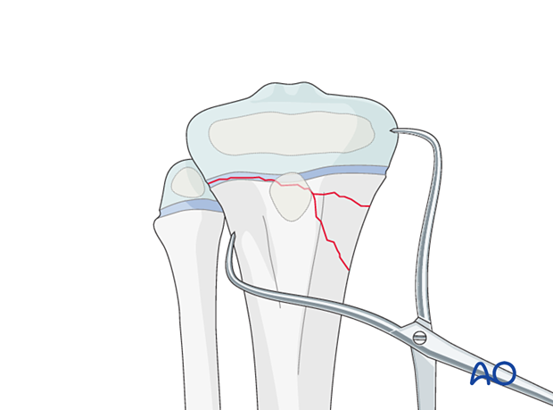 Open reduction with reduction forceps of a multifragmentary Salter-Harris type-II fracture of the proximal tibia