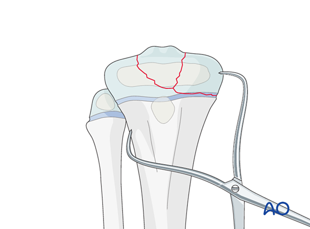 Open reduction with reduction forceps of a multifragmentary Salter-Harris type-III proximal tibial fracture