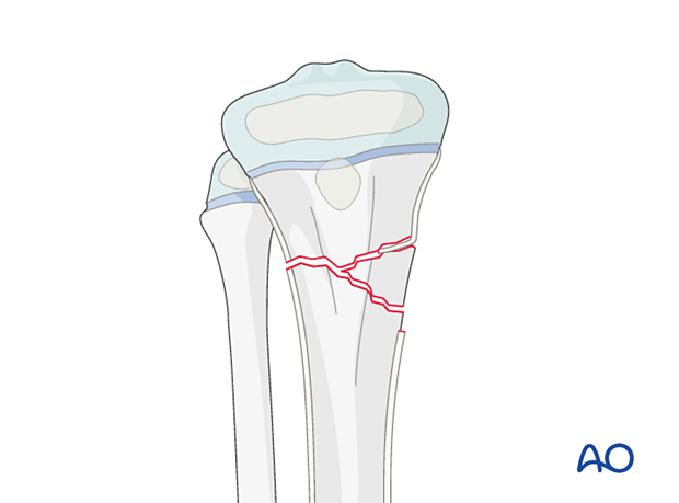 Interposed periosteum in a multifragmentary proximal metaphyseal tibial fracture