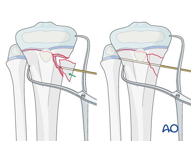 Open reduction with reduction forceps and a K-wire of a multifragmentary Salter-Harris type-II fracture of the proximal tibia