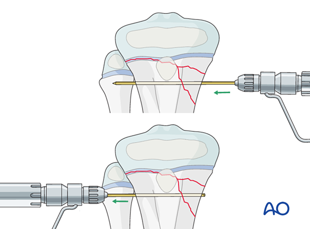 Open reduction with reduction forceps and a K-wire of a multifragmentary Salter-Harris type-II fracture of the proximal tibia