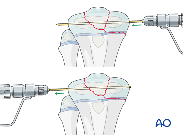 K-wire fixation of a multifragmentary Salter-Harris type-III proximal tibial fracture