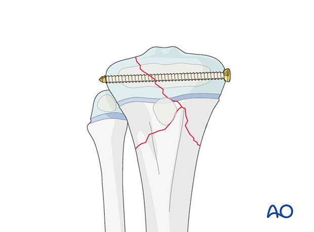 Fixation of a multifragmentary Salter-Harris type-III proximal tibial fracture with an epiphyseal screw