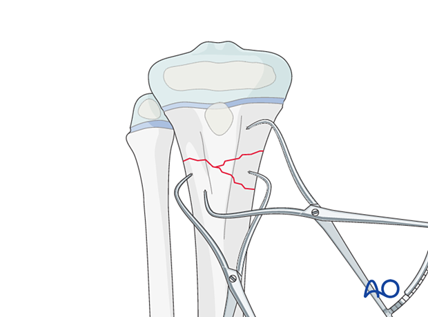 Open reduction with reduction forceps of a multifragmentary proximal metaphyseal tibial fracture