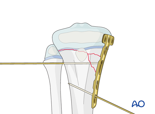 Plate application for fixation of a multifragmentary Salter-Harris type-II fracture of the proximal tibia