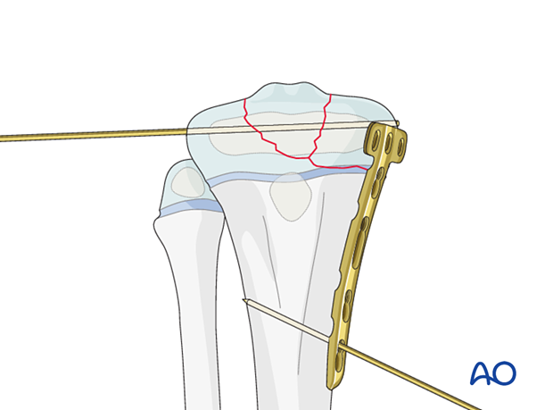 Plate application for fixation of a multifragmentary Salter-Harris type-III proximal tibial fracture