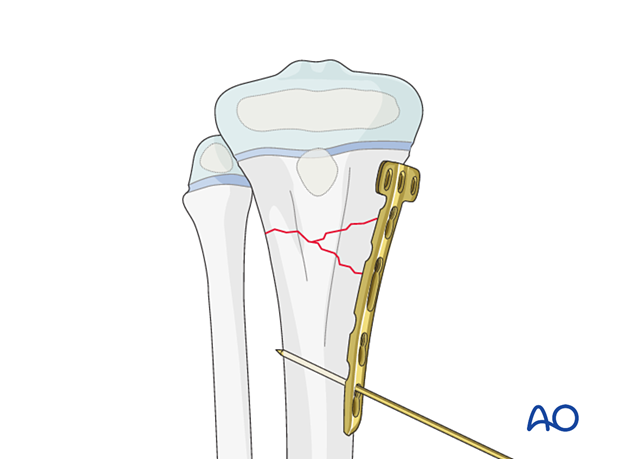 Plate application for fixation of a multifragmentary metaphyseal fracture of the proximal tibia