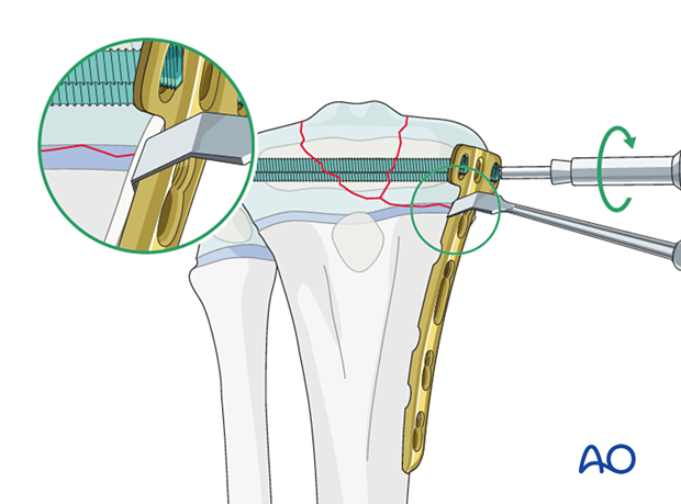 Insertion of locking-head screws in the epiphyseal region of a multifragmentary Salter-Harris type-III proximal tibial fracture