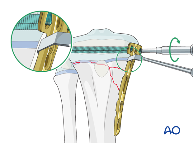 Insertion of locking-head screws in the epiphyseal region of a multifragmentary Salter-Harris type-II fracture of the proximal tibia