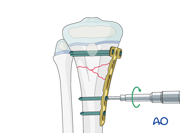 Plate fixation of a multifragmentary metaphyseal fracture of the proximal tibia