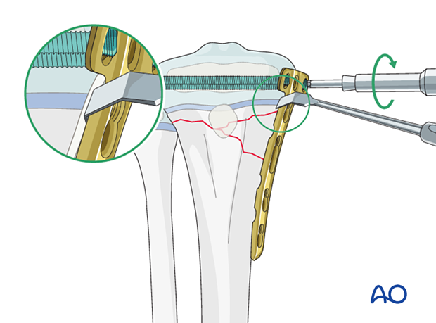 Insertion of locking-head screws in the epiphyseal region of a multifragmentary metaphyseal fracture of the proximal tibia