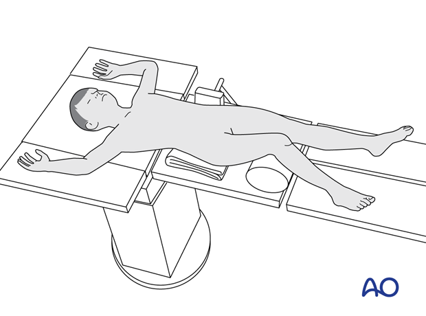 Supine position of a pediatric patient for surgery of the tibial shaft