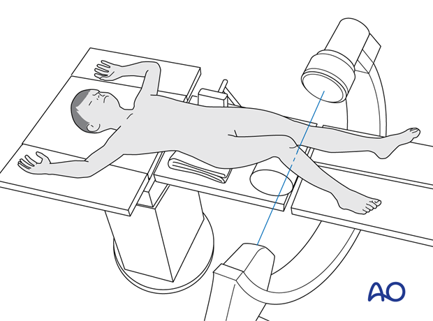 Supine position of a pediatric patient for surgery of the proximal tibia - C-arm positioning