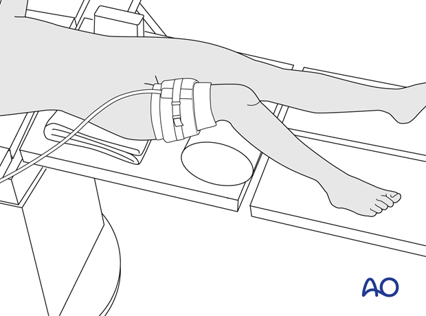 Supine position of a pediatric patient for surgery of the tibia – tourniquet position