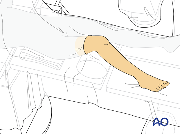 Supine position of a pediatric patient for surgery of the tibia - draping