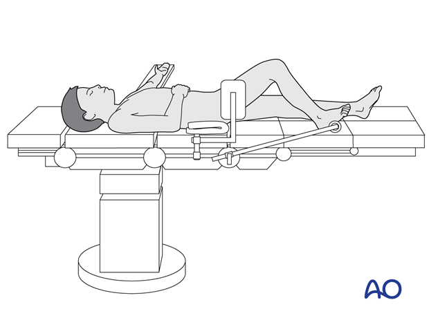 Supine position of a pediatric patient for surgery of the tibia with arthroscopy of the knee