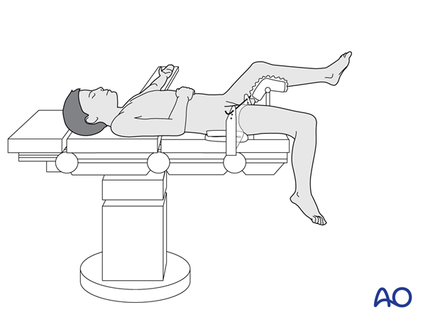 Supine position of a pediatric patient for surgery of the tibia with arthroscopy with the knee hanging over the end of the table