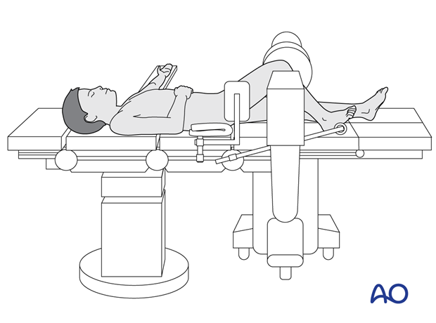 Supine position of a pediatric patient for surgery of the tibia with arthroscopy - C-arm positioning