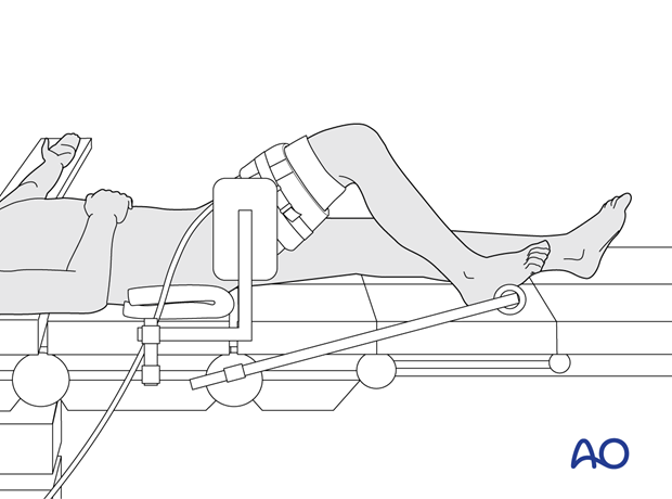 Supine position of a pediatric patient for surgery of the tibia with arthroscopy – Position of the tourniquet