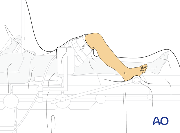 Supine position of a pediatric patient for surgery of the tibia with arthroscopy - Skin preparation and draping