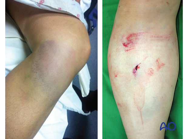 Photos of two patients with symptoms of proximal tibia injuries