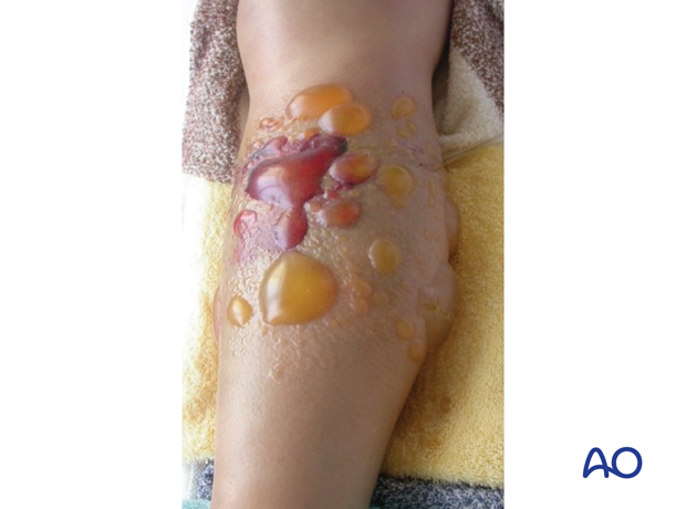 Blistering of the lower leg after a high-energy injury in a pediatric patient