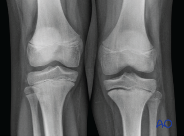 X-ray showing a case of an undisplaced Salter-Harris I fracture of the proximal tibia