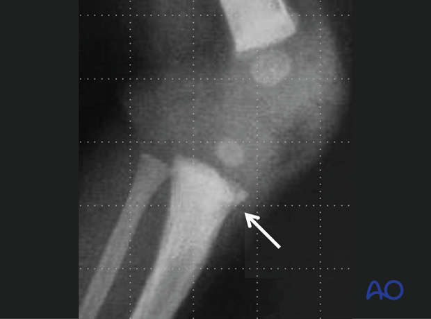 X-ray showing a case with a corner fracture