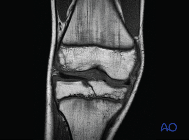 MRI scan of a Salter-Harris type-III fracture of the proximal tibia