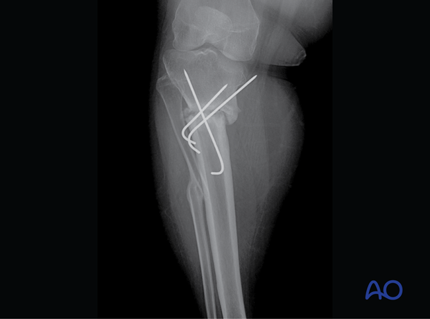 Nonunion of a metaphyseal fracture in the pediatric proximal tibia stabilized with K-wires