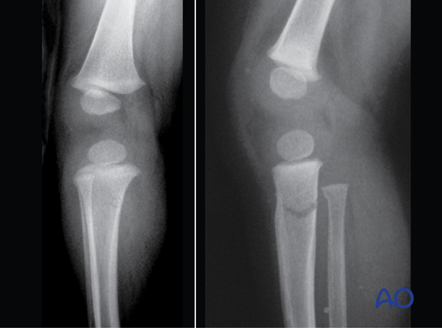 Initial x-rays showing an incomplete metaphyseal fracture of the proximal tibia in a 3-year-old child