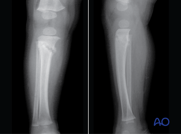 X-rays 3 weeks postinjury of an incomplete metaphyseal fracture of the proximal tibia in a 3-year-old child showing callus formation