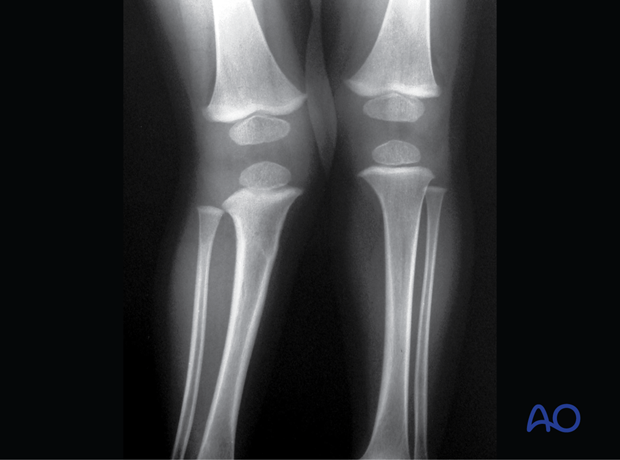 X-rays 18 months postinjury of an incomplete metaphyseal fracture of the proximal tibia in a 3-year-old child showing a valgus deromity (Cozen’s deformity)