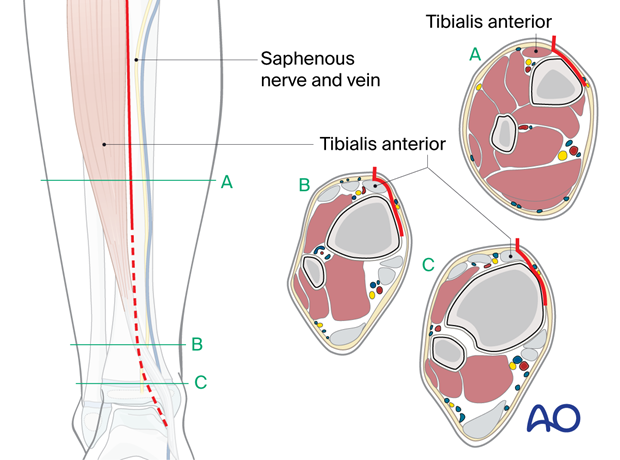 Approach to the anteromedial tibial surface in the child - Take care not to compromise the saphenous vein and nerve.