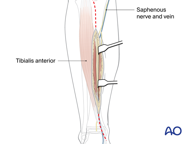 Approach to the anteromedial tibial surface in the child - Dissection