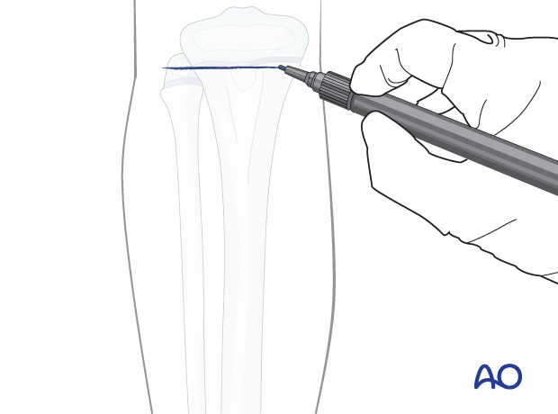 Marking the level of the proximal tibial physis