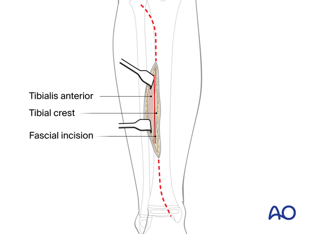 Approach to the anterolateral tibial surface in the child – Dissection