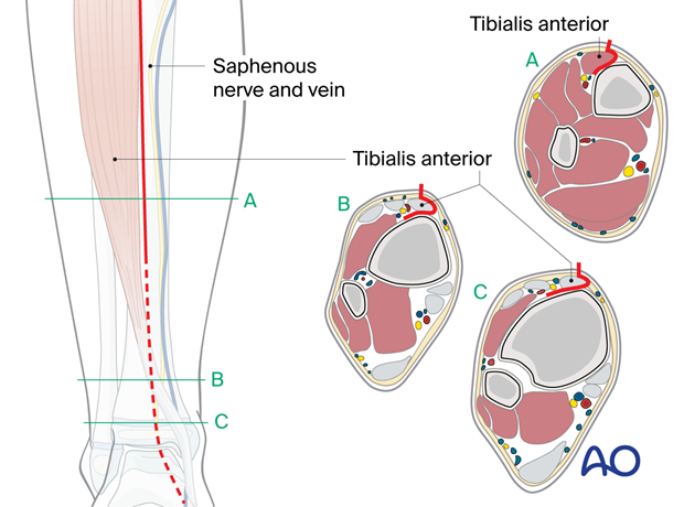 Approach to the anterolateral tibial surface in the child – Deep dissection at different levels