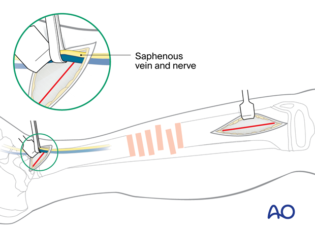 Minimally invasive medial approach to the pediatric tibia – Protection of saphenous vein and nerve