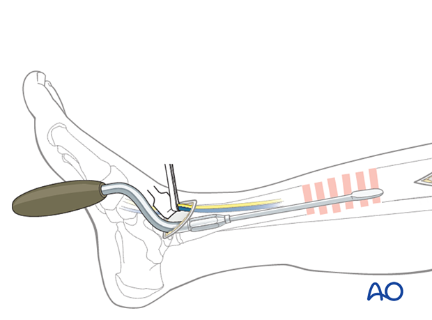 Minimally invasive medial approach to the pediatric tibia – insertion of a soft-tissue elevator