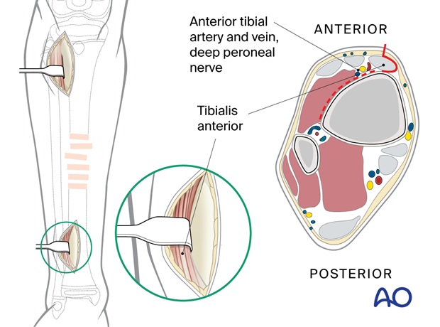 Minimally invasive lateral approach to the pediatric tibia - Distal incision