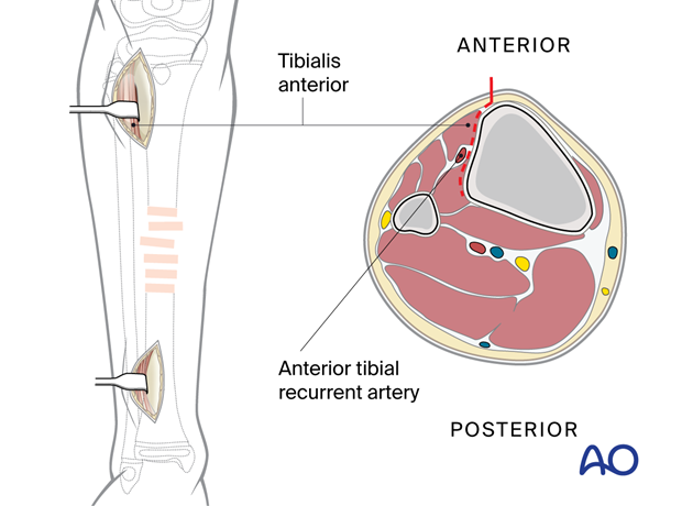 Minimally invasive lateral approach to the pediatric tibia - Proximal incision