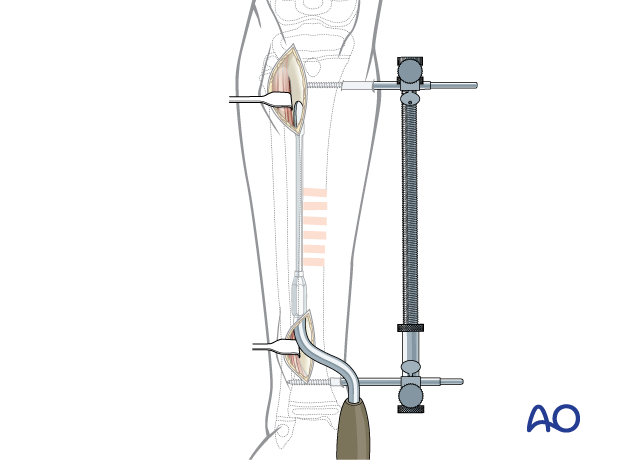 Minimally invasive lateral approach to the pediatric tibia – Soft-tissue elevator inserted.