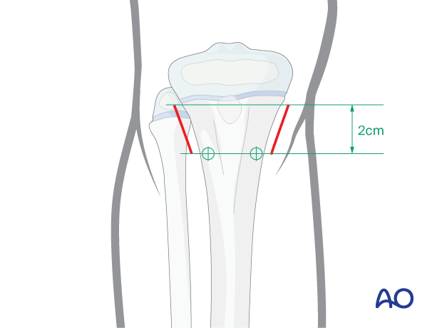 Incision to approach the ESIN entry points at the proximal metaphysis of the tibia