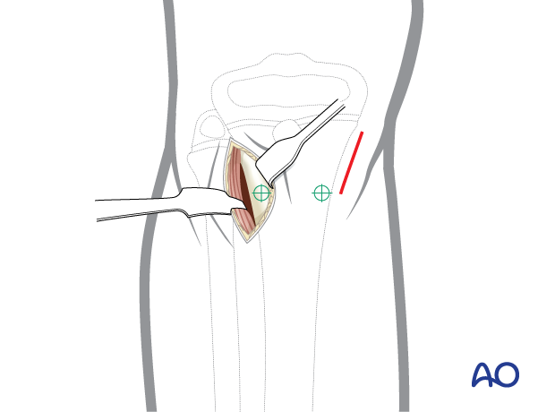 ESIN entry points for antegrade nailing of the pediatric tibia - Deep dissection