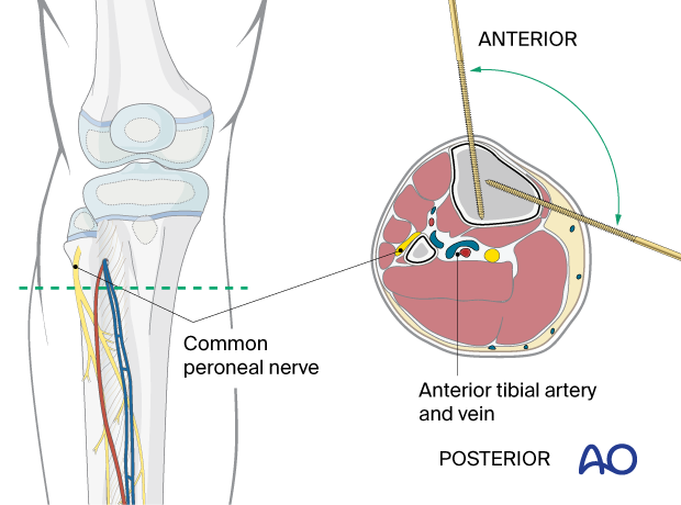 Safe zones for pin placement in the pediatric tibia – Pin insertion in the proximal third